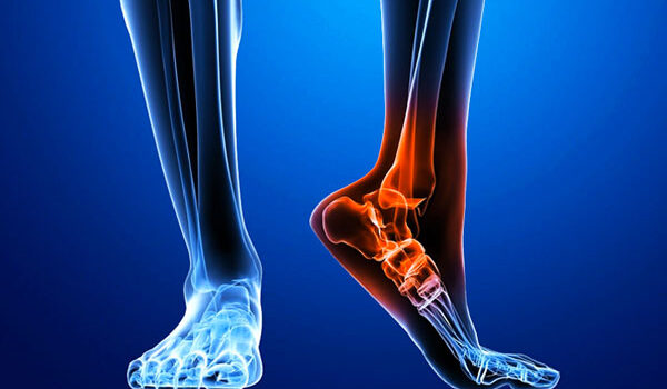 Cuboid Syndrome cuboid-syndrome-graphic