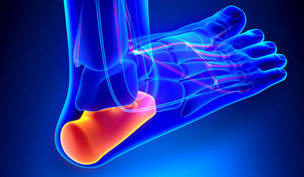 Planar Fascitis plantar-fasciitis-graohic